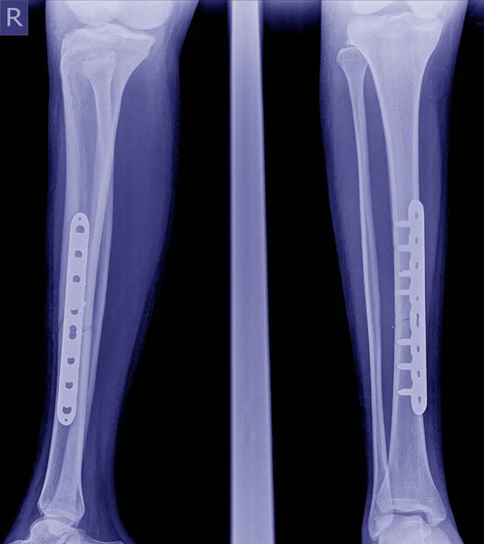 Broken leg x-rays image,x-ray image of fracture leg ( tobia )with implant plate and screw.