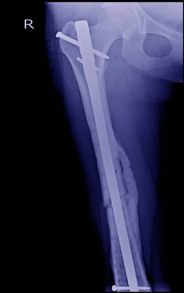 Fractured Femur, Broken leg x-rays image,x-ray image of fracture leg ( femur )with implant — Stock Image Fractured Femur Broken Leg Rays Image Ray Image Fracture Leg Stock Photo