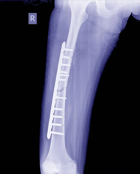 Fractured Femur, Broken leg x-rays image,x-ray image of fracture leg ( femur )with implant plate and screw. — Stock Image Fractured Femur Broken Leg Rays Image Ray Image Fracture Leg Royalty Free Stock Images