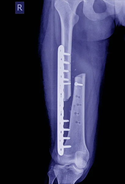 Fractured Femur, Broken leg x-rays image,x-ray image of fracture leg ( femur )with implant plate and screw dislocation. — Stock Image Fractured Femur Broken Leg Rays Image Ray Image Fracture Leg Stock Photo