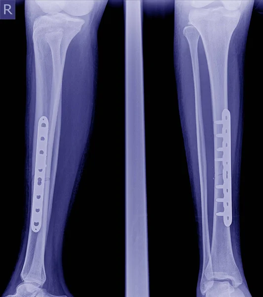 Broken leg x-rays image,x-ray image of fracture leg ( tobia )with implant plate and screw. — Stock Image Broken Leg Rays Image Ray Image Fracture Leg Tobia Implant Stock Image