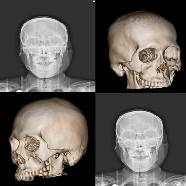 3D Computed tomografi (3d tomografi) yüz kemik, birden çok kırıklar yüz kemik olgusu