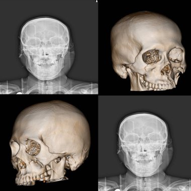 3D Computed tomography(3D CT-scan) of facial bone, case of multiple fractures of facial bone clipart