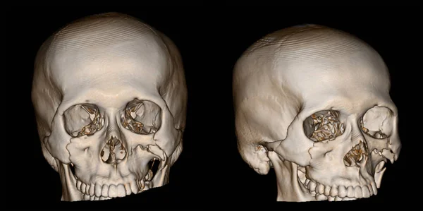 3-D rendering image of a patient skull with traumatic brain injury showing fracture of both orbital rim and left zygomatic fracture.