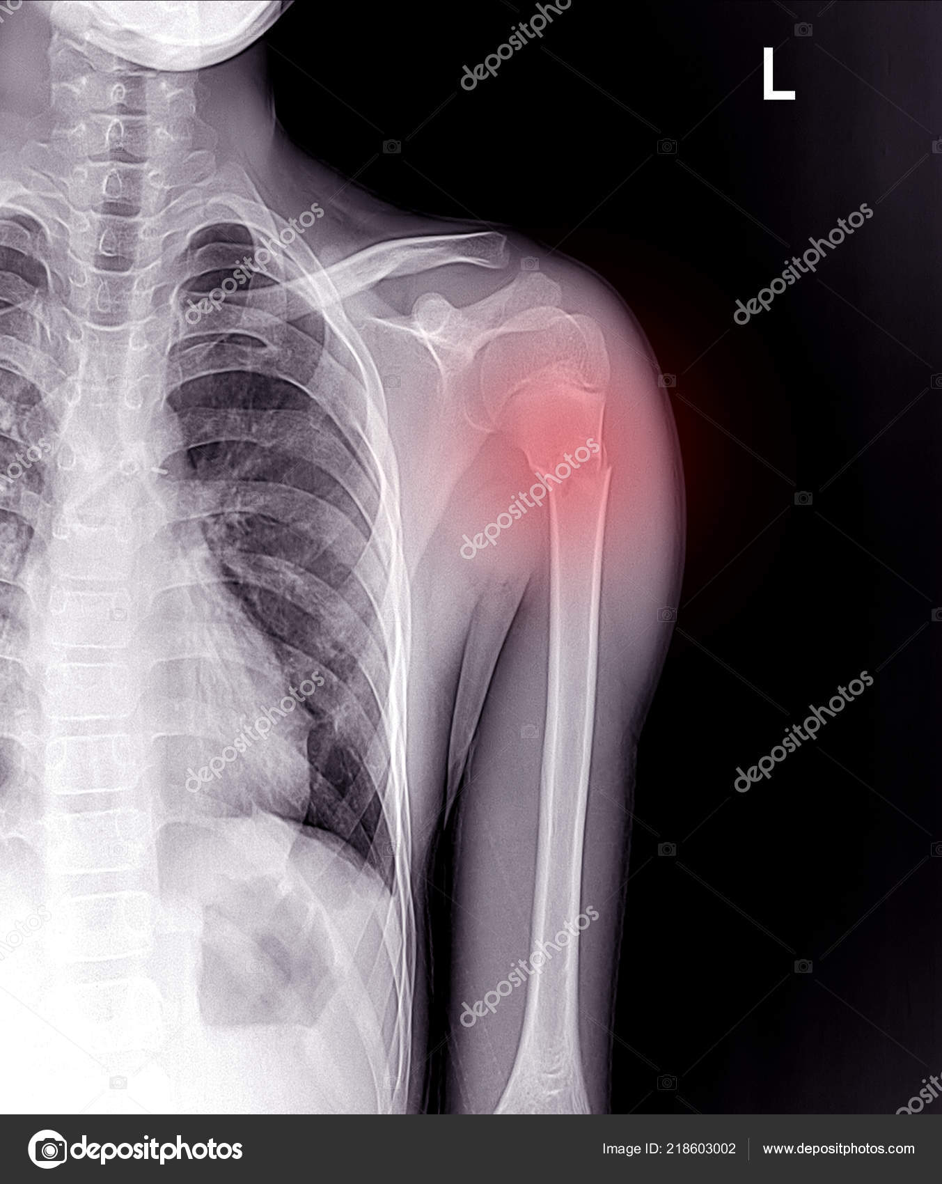 Une Fracture Cou L'humérus Bras image libre de droit par Richmanphoto