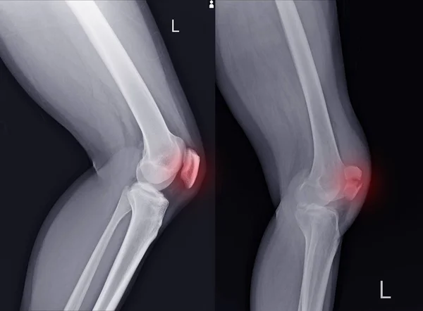 Rayos Rodilla Izquierda Lateral Mostrando Rótula Normal Fractura Marcador Color —  Fotos de Stock