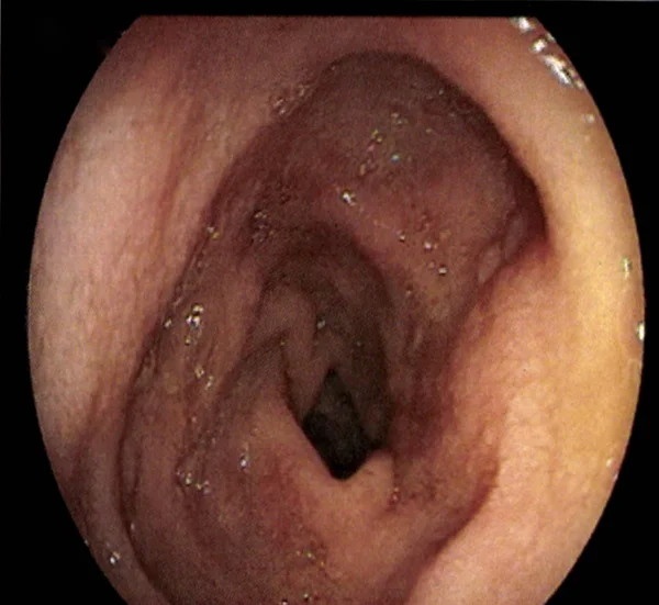 Zpráva Esophagogastroduodenoscopy Nebo Egd Medicínských Obrazových — Stock fotografie