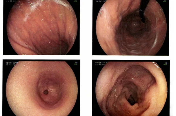 Rapor Esophagogastroduodenoscopy veya Egd tıbbi görüntü.