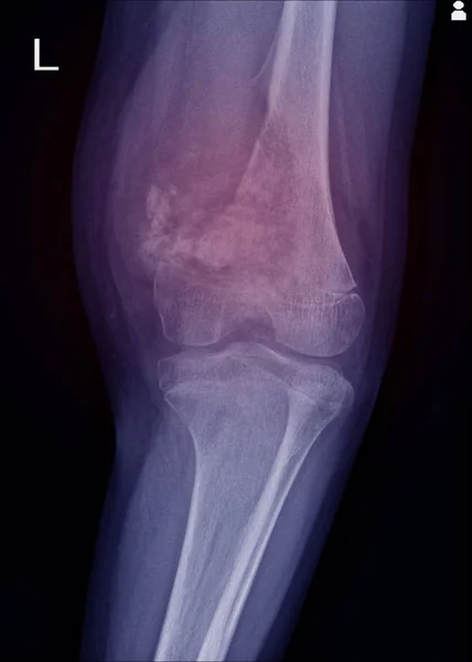 线膝关节显示大溶骨性 Lesuion 左远端股骨内侧 与软软组织肿块和恶性骨肿瘤 骨肉瘤被怀疑 — 图库照片