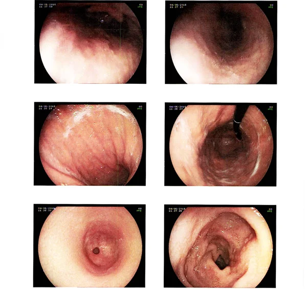 Rapor Esophagogastroduodenoscopy veya Egd tıbbi görüntü.