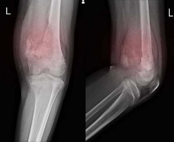 X-ışını diz sol distal femur.with yumuşak tissure mass.and malign kemik tümörü medial yönü gösteren büyük osteolitik lesuion katılmak, osteosarkom şüpheleniliyor.