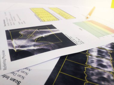Yumuşak ve bulanık görüntü: kemik Dansitometresi kalça ve lumbarspine Result.on parlak arka plan