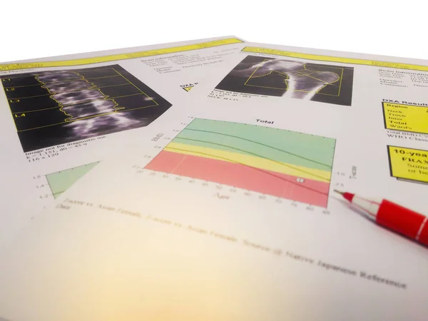 Informe Densidad Ósea Cadera Columna Lumbar — Foto de Stock