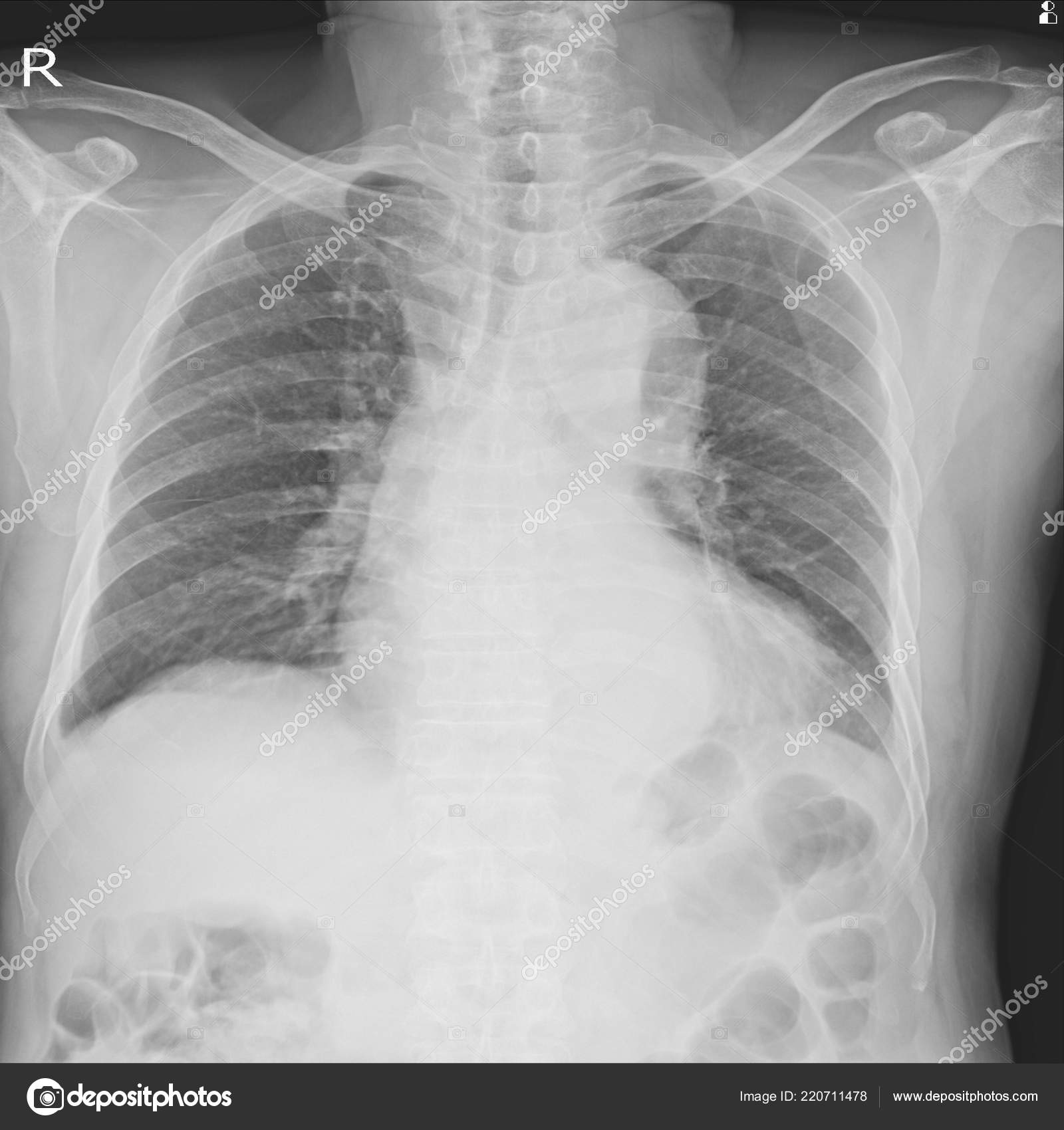 Pulmonary Edema Stock Photos Royalty Free Pulmonary Edema Images Depositphotos Pulmonary Edema Stock Photos Royalty Free Pulmonary Edema Images Depositphotos