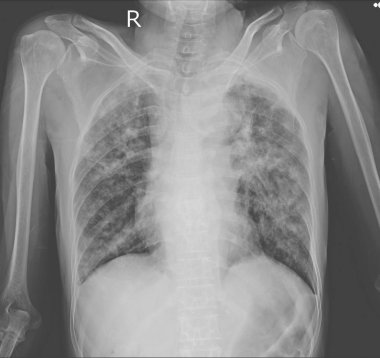 Her iki akciğer interstisyel pulmoner infiltrasyon Kuru çürük ile gösterilen göğüs röntgeni. İzlenim: Akciğer tüberkülozu
