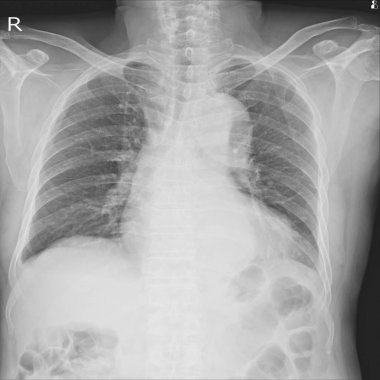 Göğüs gösteren x-ışını. Şiddetli kardiyomegali. Her iki costophrenic açıları açıktır. Sağlam kemik structuresevere kardiyomegali. İnfiltrasyon Lt alt Ddx. pnömoni, pulmoner ödem
