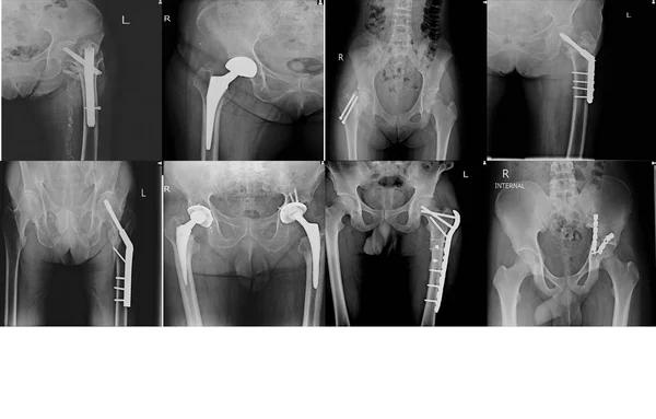 Coleção Raios Cirurgia Ortopédica Múltiplo Quadril Humano Operar Fixação Interna — Fotografia de Stock