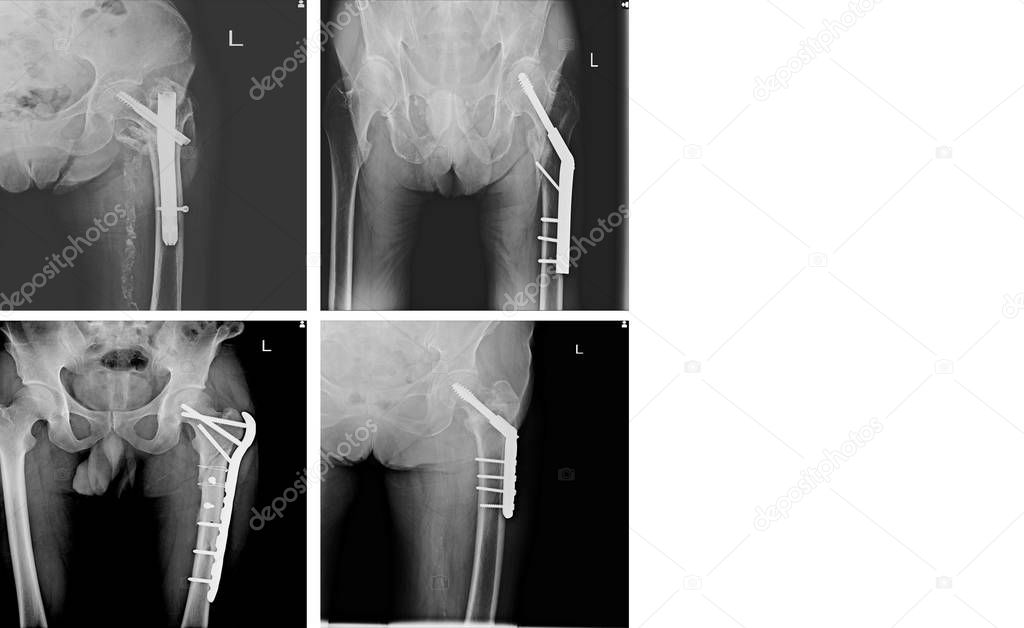 X-ray Collection orthopedic surgery (Multiple hip human, operate and internal fixation by plate and screw )with copy space.