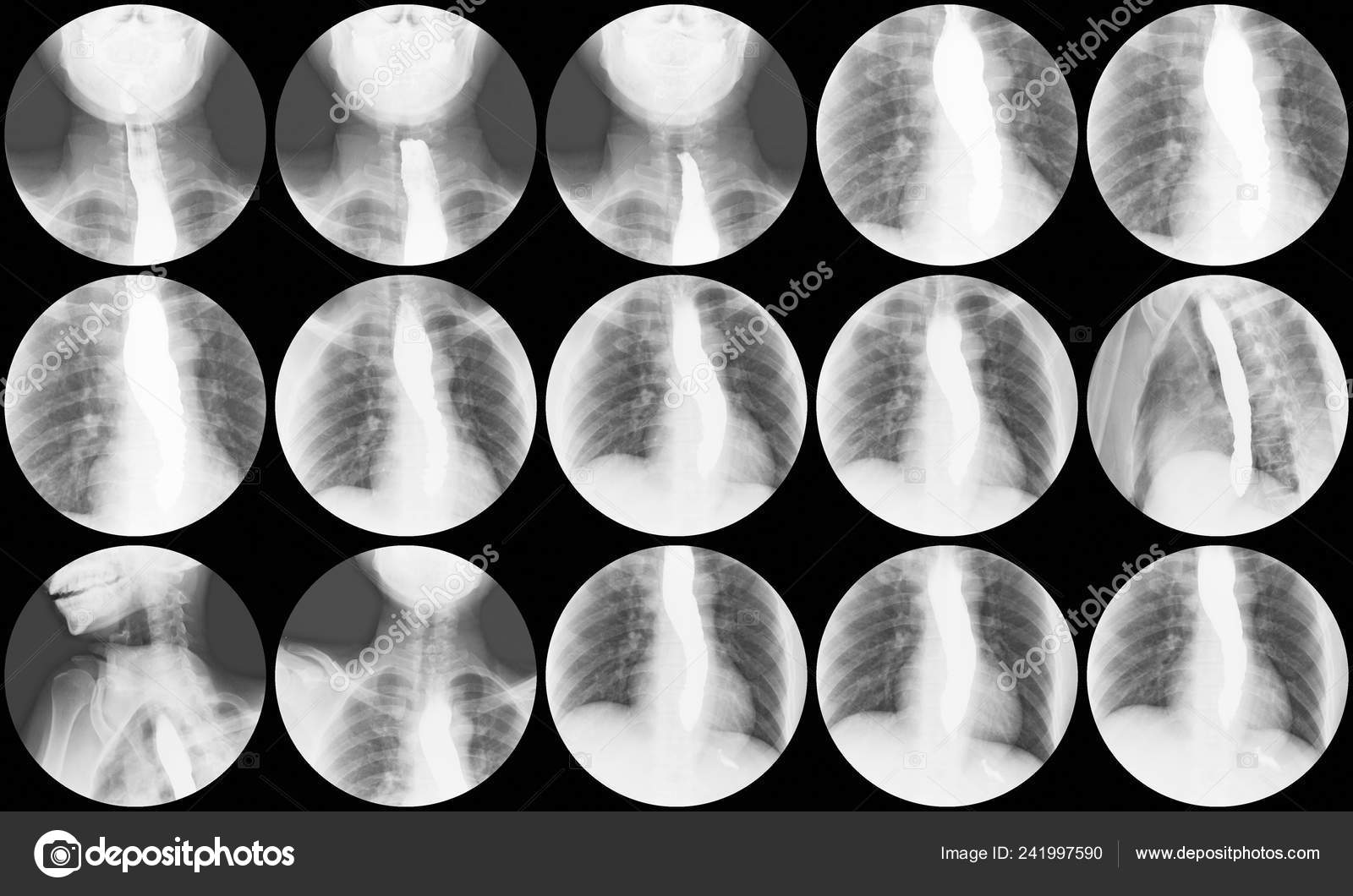 Barium Swallow Ray Study Reveals Bird Beak Sign Distal Esophagus