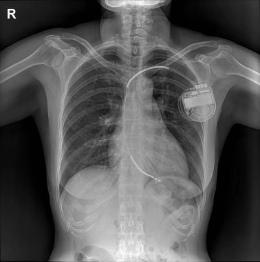 pacemaker showing in chest x-ray clipart