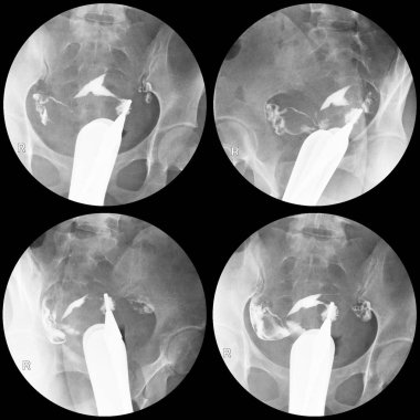 hysterosalpingography radiology The uterus is normal size and shape.Both tubes appear normal,Good spillage of contrast to peritoneal cavity,bilaterally. clipart