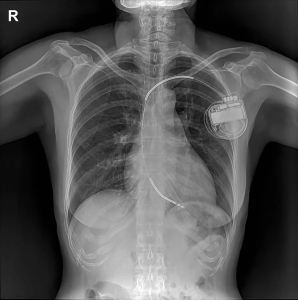 Pacemaker Showing Chest Ray — Stock Photo, Image