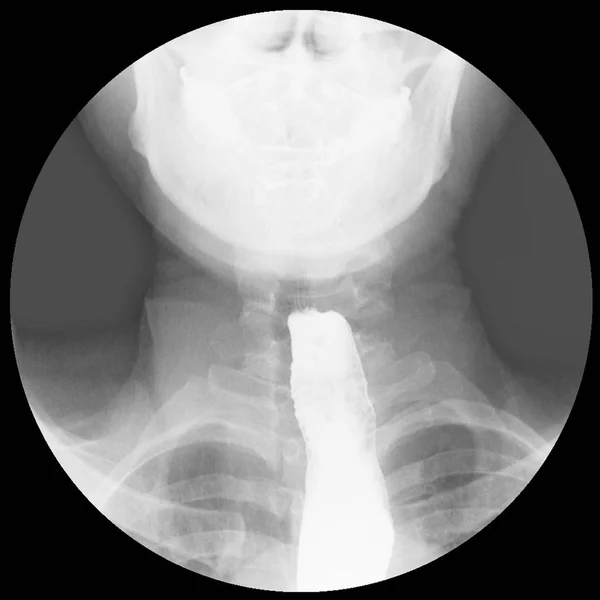 Radiografía Deglución Del Bario Evidencia Acalasia Esófago Distal Unión Dialtación — Foto de Stock