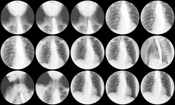 Baryum swallow x-ray çalışma esophagogastric (Eg) Kavşağı için distal yemek borusu kuş gagası tabelaya ortaya koymaktadır.