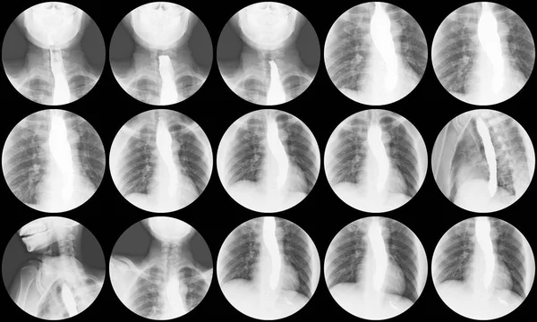Barium Schlucken Röntgenbild Der Studie Zeigt Vogelschnabelzeichen Distalen Ösophagus Zur — Stockfoto