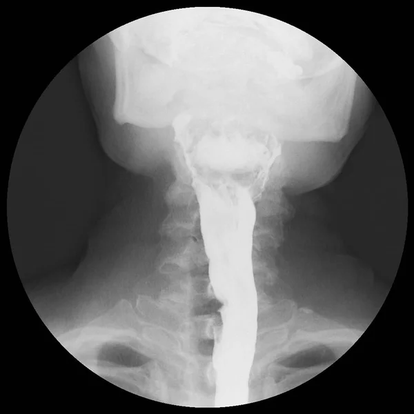 Specjalne Ecamination Baruim Połknąć Normalnego Połykania Funcion Normalny Pyriform Sinus — Zdjęcie stockowe