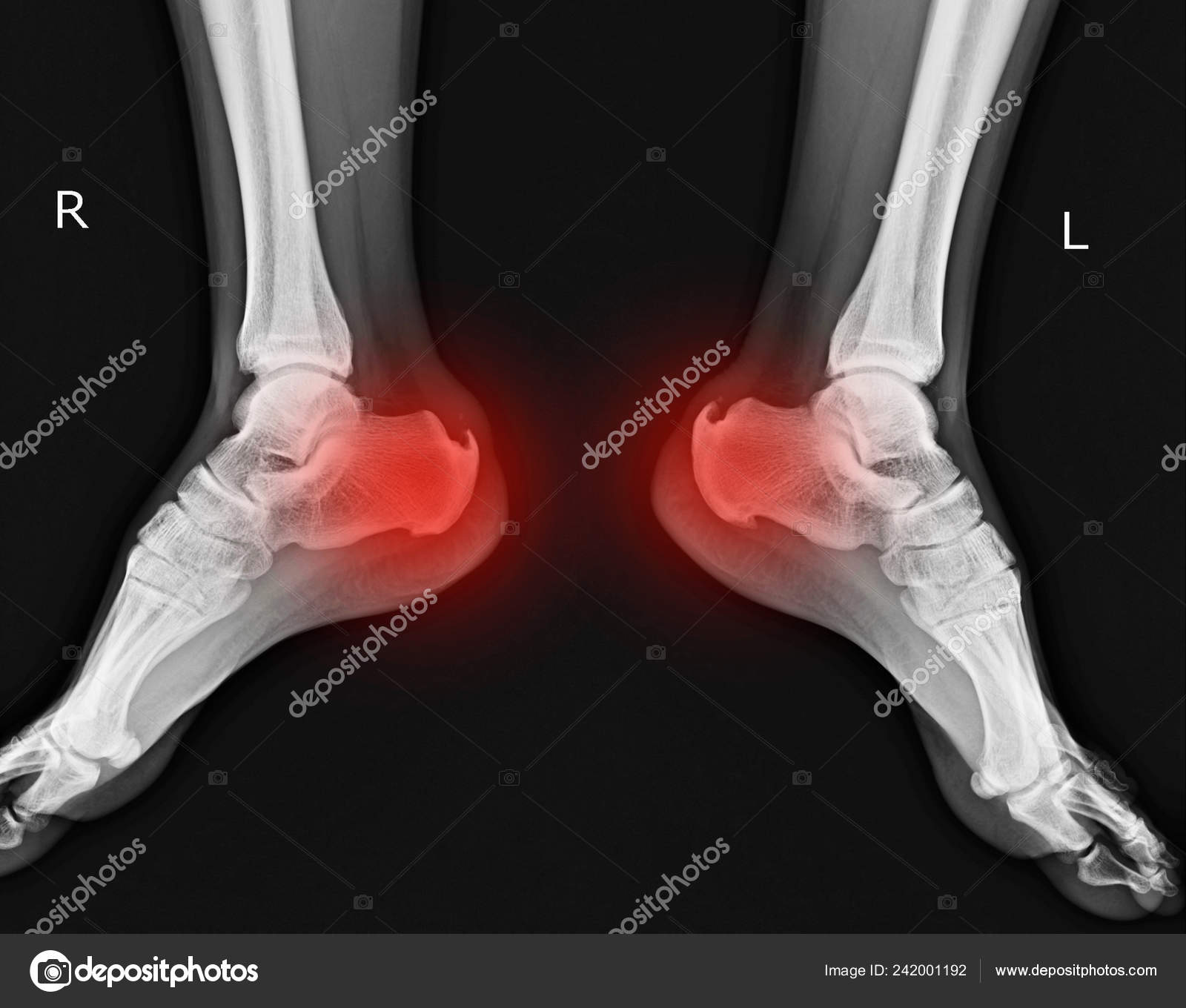Bone Spurs Calcaneal Spur Fracture On Side Of Spur In My Foot Bone