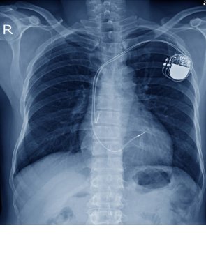 x-ışını görüntüsünü kalıcı kalp pili implantı göğüs vücut, mavi tonu kopya alanı ile sürecinde.