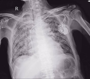 kalıcı kalp pili x-ray görüntü vücut göğüs implantı.