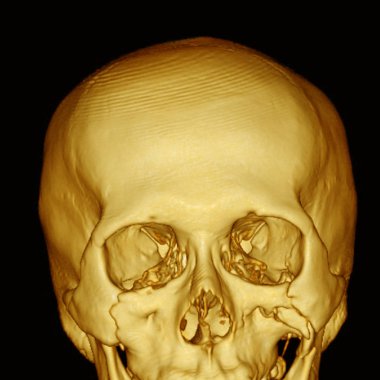 Computed tomography (3DCT scan) of facial bone, showing multiple maxillofacial fractures.Traffic acident. clipart