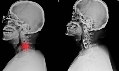 X-ışını C-Spines gösteren S/p internal fiksasyon C4-C5 ve C6 plaka ve vida ile ve hypersignal yoğunluk lezyon spinal kord C4 C6 düzeylere.