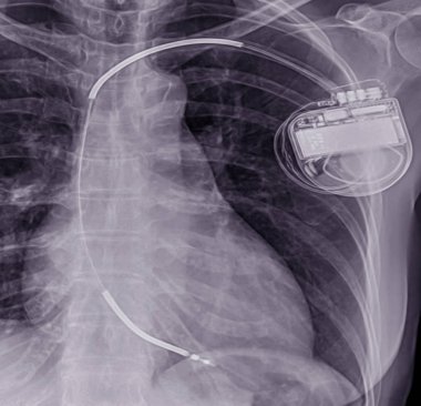 Close up Chest x-ray showing Pacemaker clipart