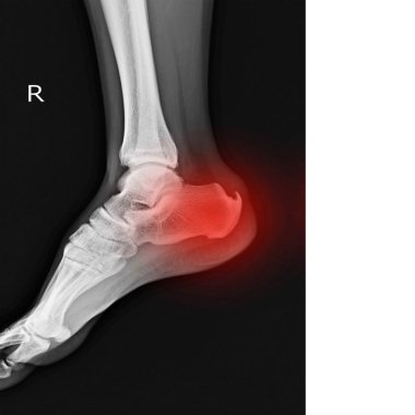 Sağ ayak Calcaneal gösterilen x-ışını kopya alanı ile kırmızı renk üzerinde teşvik.