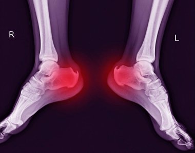 X-ray both foot showing Calcaneal spur on red color. clipart