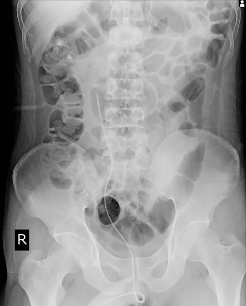 Ακτινογραφία Κοιλίας Δείχνει Stent Στη Δεξιά Ureter Too Μαλακό Όταν — Φωτογραφία Αρχείου