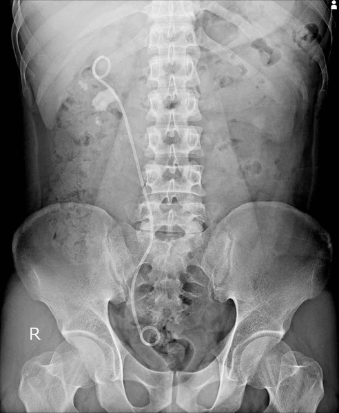 Рентгенівський Знімок Черевної Порожнини Показує Подвійний Стент Полегшення Колон Каменю — стокове фото