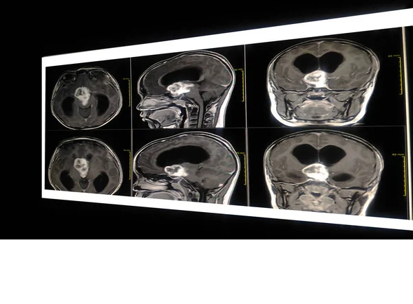 Resonancia Magnética Cerebro Órbita Niño Años Mostrando 5Cm Masa Supraselar —  Fotos de Stock