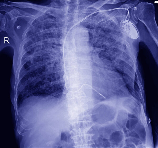 pacemaker in x-ray image in cardiac catheterization laboratory
