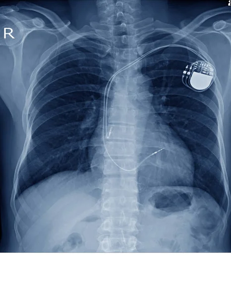 Imagem Raio Implante Marca Passo Permanente Corpo Torácico Processo Tom — Fotografia de Stock