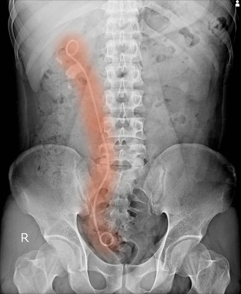 Radiografía Abdominal Que Muestra Stent Doble Para Aliviar Los Cólicos — Foto de Stock