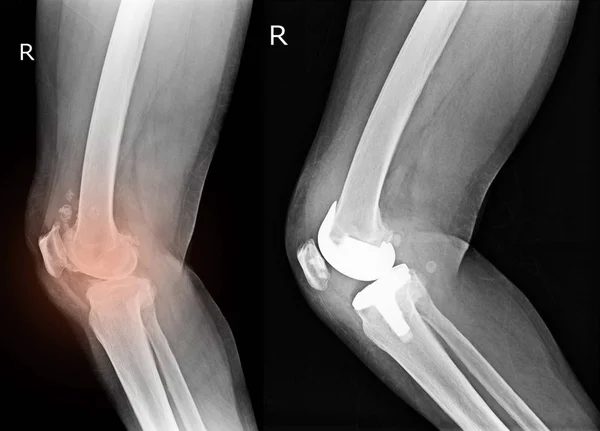 X-ray showing OA knee and knee with total replacement x-ray image ob black background.