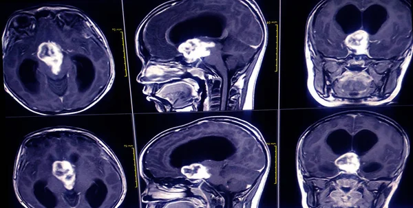 Resonancia Magnética Cerebro Órbita Niño Años Mostrando 5Cm Masa Supraselar — Foto de Stock