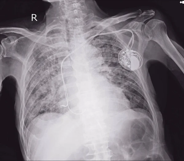 Röntgenbild Eines Permanenten Schrittmacherimplantats Der Brust Des Körpers — Stockfoto