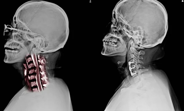 Rayos Spines Mostrando Fijación Interna Con Placa Tornillos Hay Lesión —  Fotos de Stock