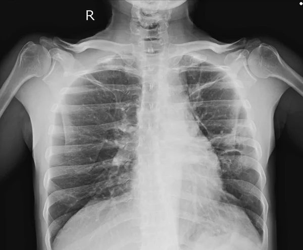 Röntgenbild Der Brust Das Einen Großen Knoten Auf Pleurabasis Oberen — Stockfoto