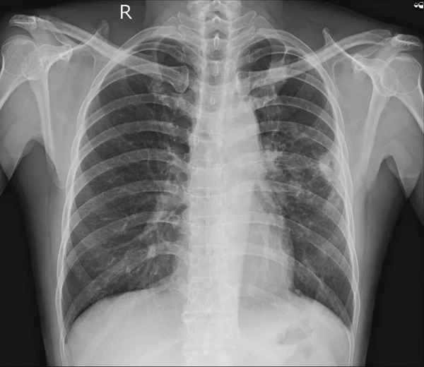 光片显示3厘米胸膜为基础的结节在上部叶 具分裂的边缘 附近胸膜增厚 结节浸润在 Rul 正常的心脏大小 鉴别诊断钙肺 肉芽肿 — 图库照片